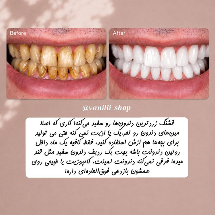 ژل سفیدکنند فوری دندان بنفش